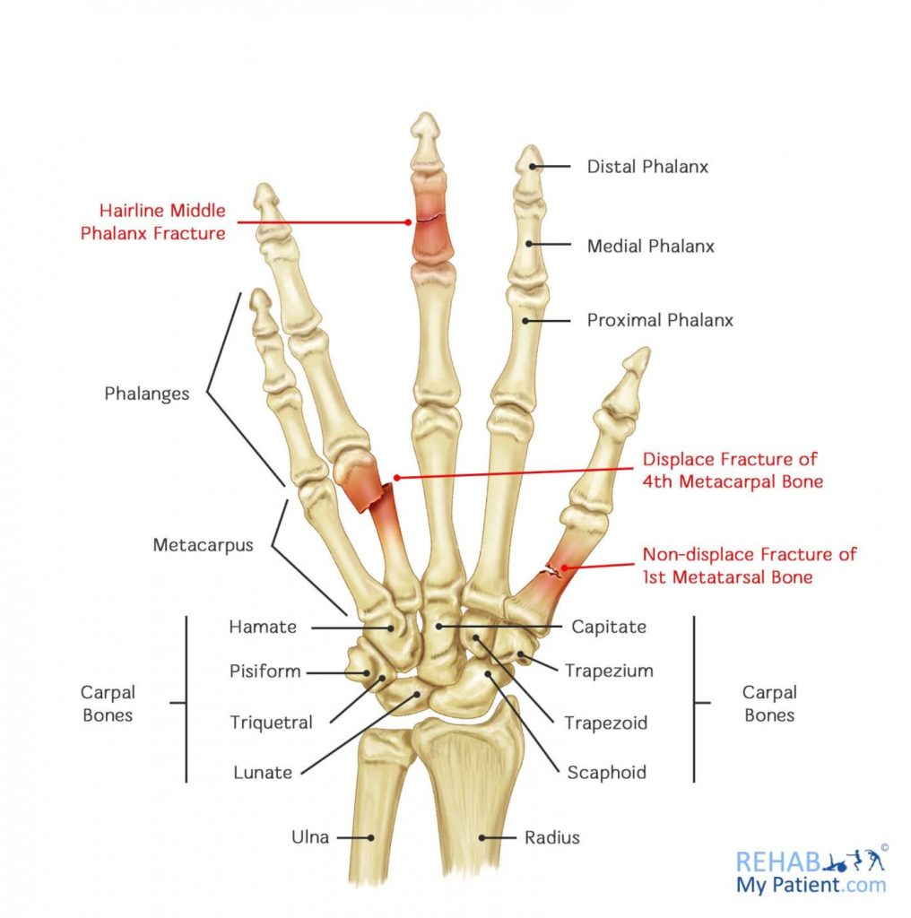 Esquema de una fractura de dedo