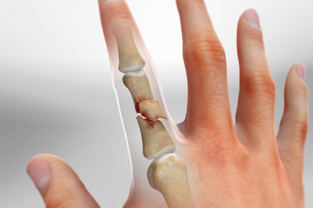Diagrama de una fractura de dedo