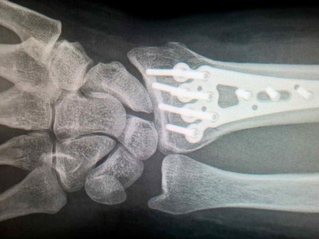 Fractura distal de Radio