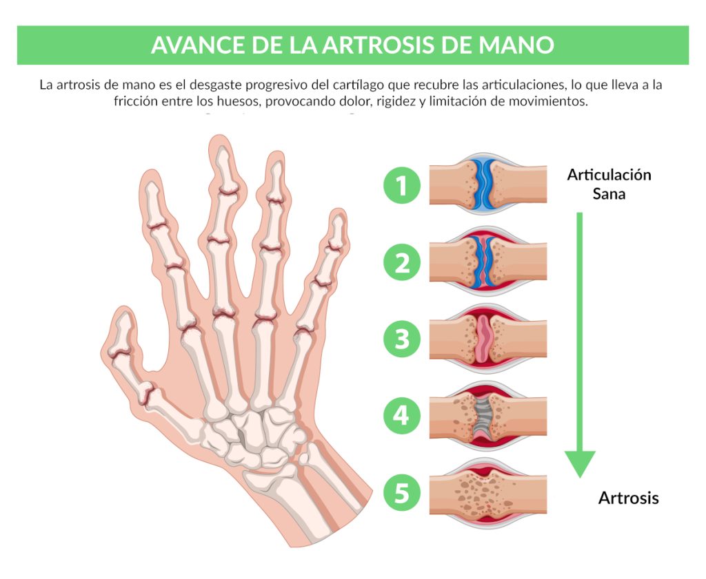 Infograma Etapas de la Artrosis de Mano