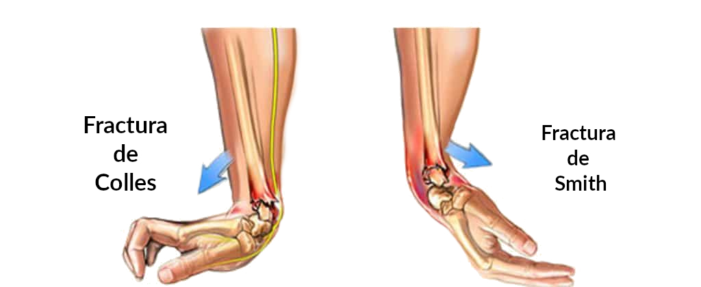 Fractura de Colles y Fractura de Smith
